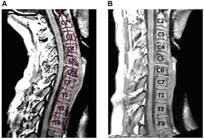 Neck Muscle Changes Following Long-Duration Spaceflight